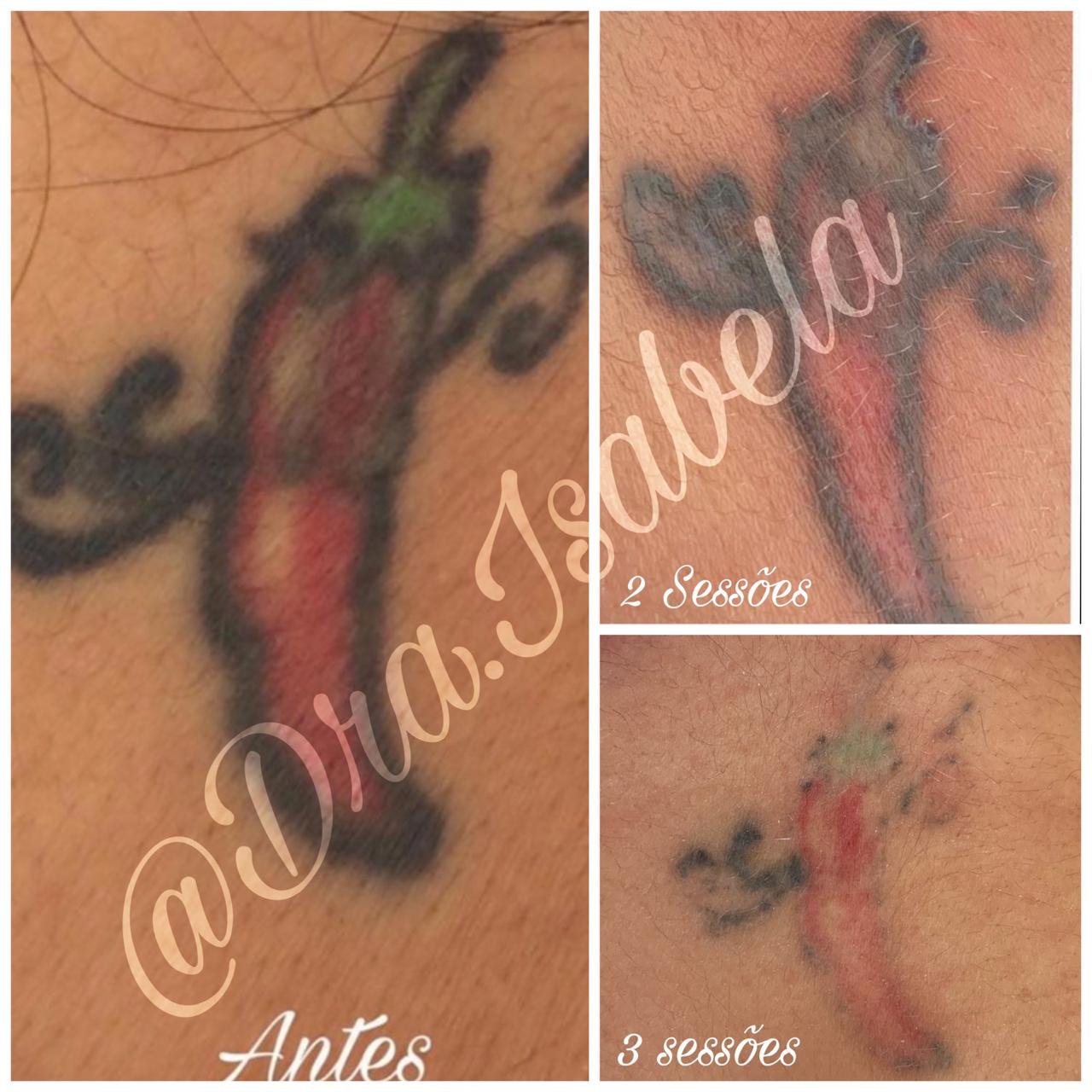 Clareamento de tatuagens ou micropigmentação de sobrancelhas
